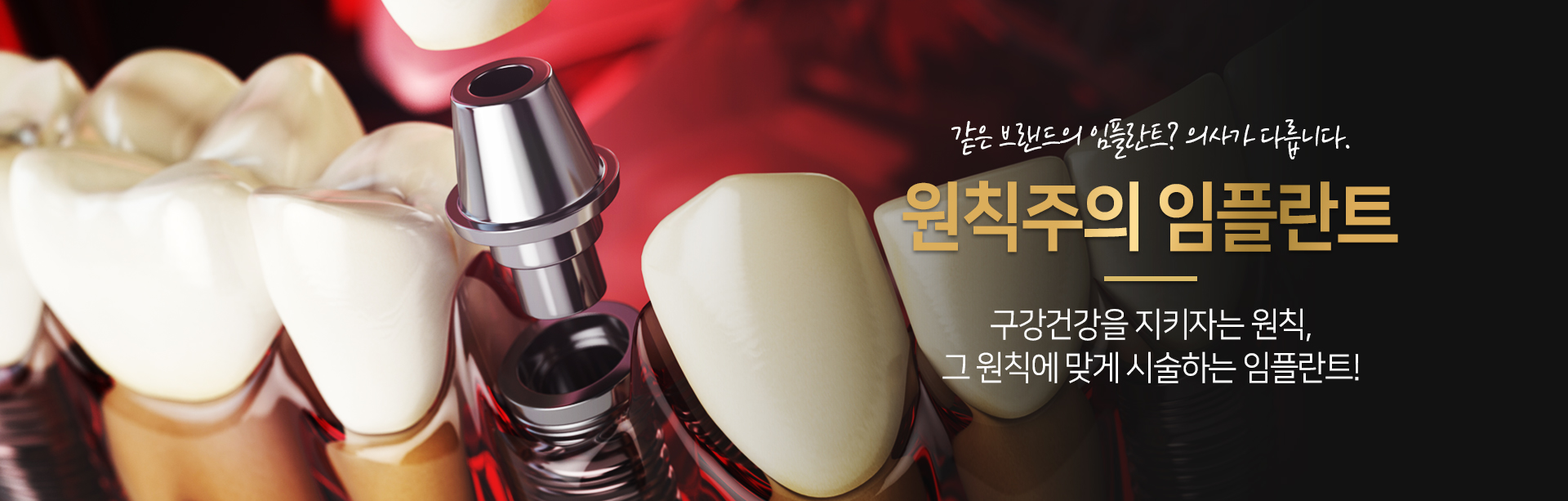 원칙주의 임플란트